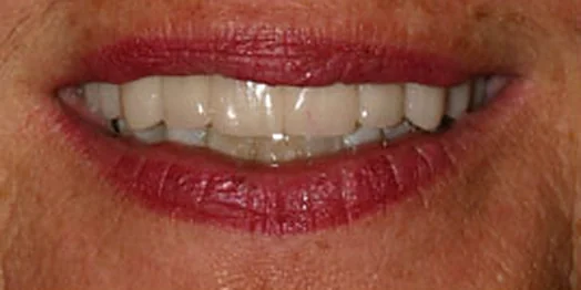 Lisa, after treatment at Masters of Dentistry: the same smile restored.