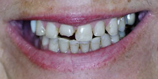 Lisa, before treatment: a close view of the smile.
