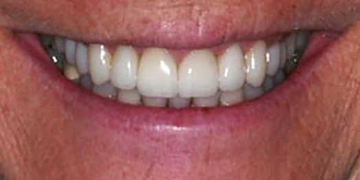 Jo Ann, after treatment at Masters of Dentistry: the same smile restored.