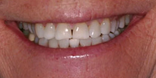 Jo Ann, before treatment: a close view of the smile.