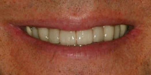 Tony, after treatment at Masters of Dentistry: the same smile restored.