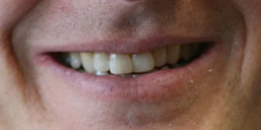 Tony, before treatment: a close view of the smile.